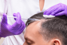 Are There Any Risks or Side Effects of PRF Hair Regrowth?